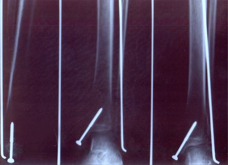 Broken leg x ray with screws inside