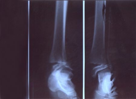 Broken leg x ray