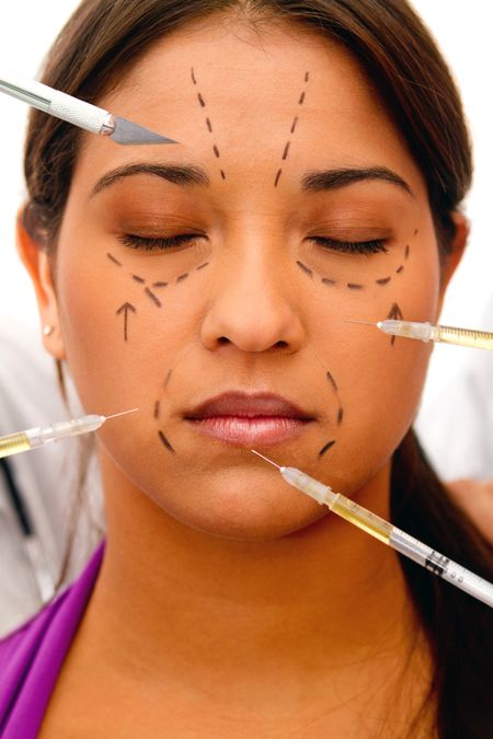 Woman going into surgery with face lift marks